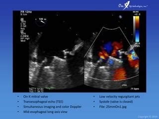 On-X Heart Valve Echocardiography | PPT