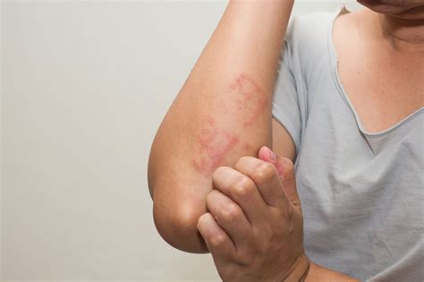 Eczema | Atopic Dermatitis | Inflamed Skin