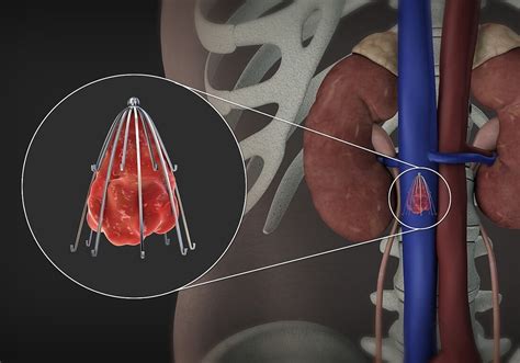 Inferior Vena Cava Filter