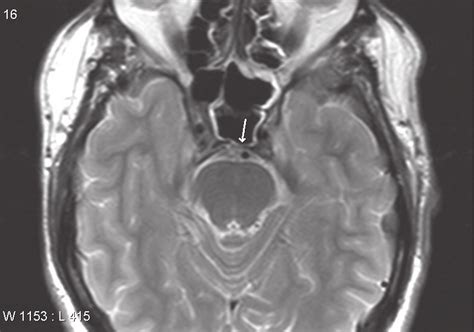 Axial T2-weighted MR image through the clivus taken 16 months after the ...