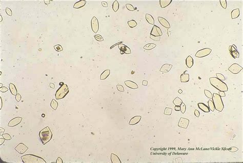 Uric Acid Crystals in Urine | Medical Laboratories