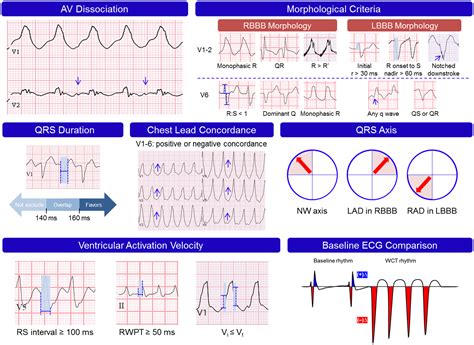 Wide Qrs Complex Tachycardia