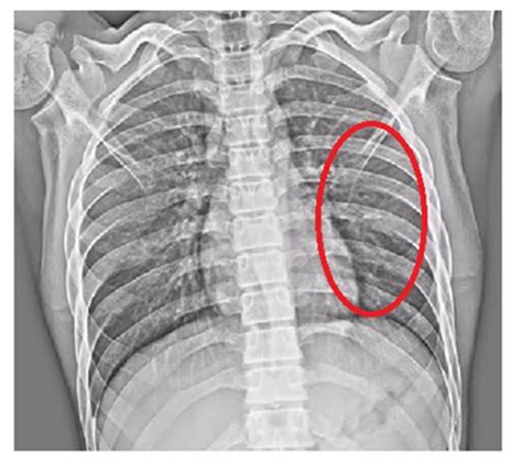 Rib Fracture Ct Scan