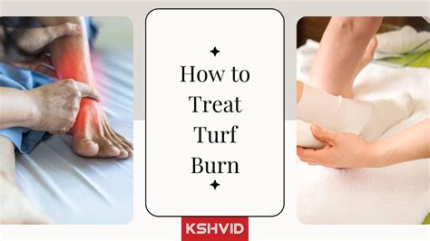 How to Treat Turf Burn - Symptoms and Treatment - KSHVID