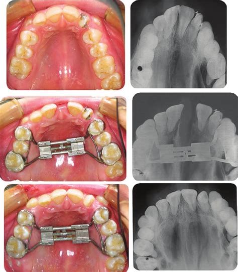 Occlusal photographs with radiographs at the beginning of the treatment ...