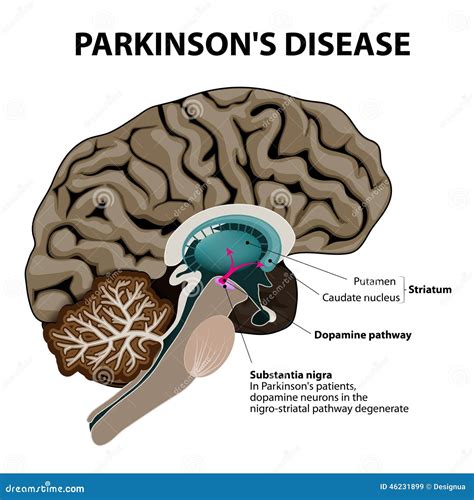 Parkinsons Disease Stock Vector - Image: 46231899