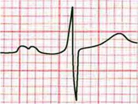 ECG / EKG Rhythms