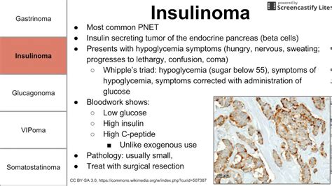 Functional pancreatic neuroendocrine tumors | Doovi