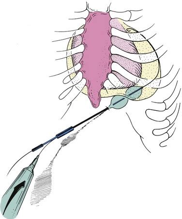 Percutaneous Balloon Pericardiotomy for Patients with Pericardial Effusion and Tamponade ...