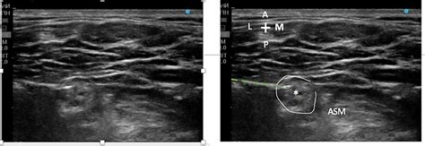 Cureus | Ultrasound-Guided Upper Trunk Perineural Catheter for Shoulder Surgery: A Description ...