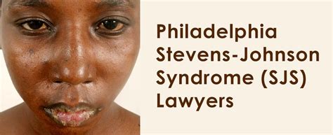 Philadelphia Stevens-Johnson Syndrome (SJS) Lawyers - 215.546.2604 Feldman & Pinto