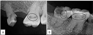 Dentine Dysplasia Type II: Report of a Rare Case with Radiographic Criteria of Type I