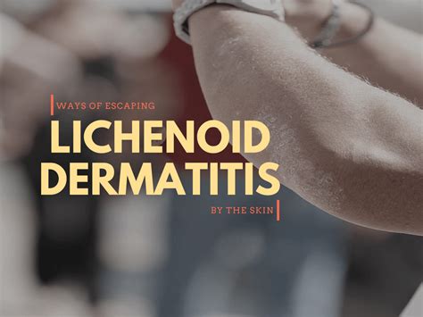 Lichenoid Dermatitis: Treatments, Causes, Symptoms - https://healthyskinadviser.com/lichenoid ...