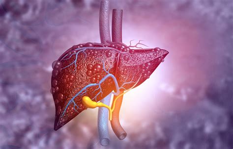 Fatty Liver Disease (Hepatosteatosis): Diagnosis, Causes & More