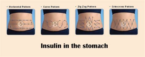 Insulin Injection Sites Diagram Printable - prntbl ...