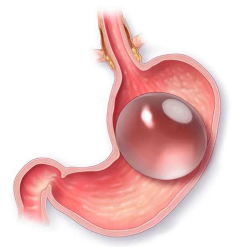 Gastric Balloon New Jersey | Advanced Surgical Solutions