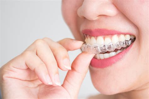 Everything You Need to Know About Invisalign - Kennett Road Dental Surgery Oxford