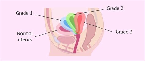 Uterus Tipped Backwards: Causes & Symptomes of Retroverted Uterus