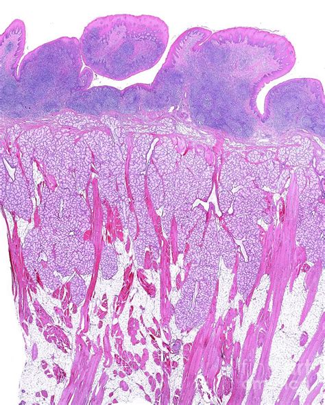 Lingual Tonsil Histology