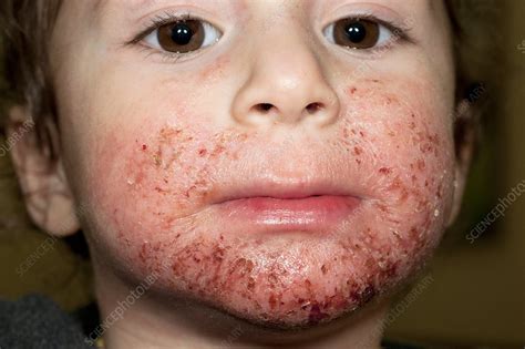 Atopic dermatitis on face of a child - Stock Image - C011/0355 ...