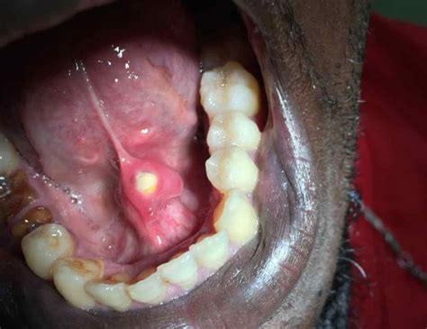 Image of the Week: A Hard Lesion Near the Frenulum of the Tongue ...