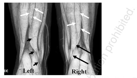 Figure 1 from Regeneration of the semitendinosus tendon after its harvesting for anterior ...