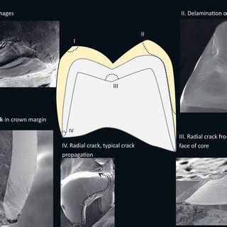 Different fracture types observed in clinical failures. I) chipping ...