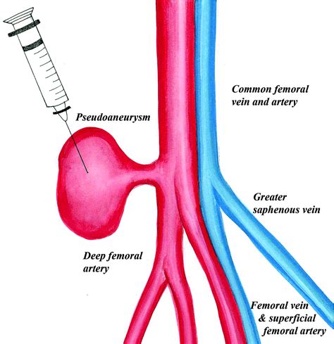 Contemporary Management of Postcatheterization Pseudoaneurysms | Circulation