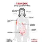 Anorexia Nervosa: Causes, Symptoms And Treatments