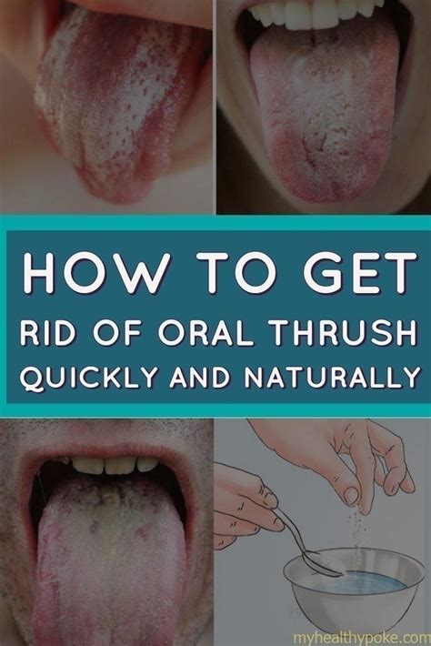 9 Methods for How to Battle Oral Thrush | Oral thrush remedies, Oral thrush treatment, Oral