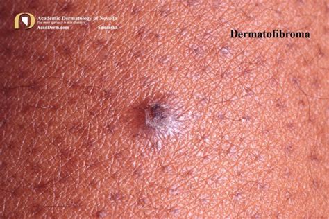 Dermatofibroma: Benign Fibrous Histiocytoma... - Academic Dermatology of Nevada