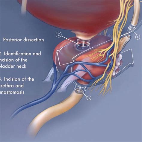 Retzius-sparing radical prostatectomy key steps | Download Scientific ...