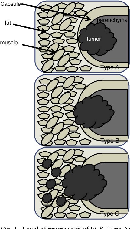 Figure 1 from Evaluation of the level of progression of extracapsular spread for cervical lymph ...