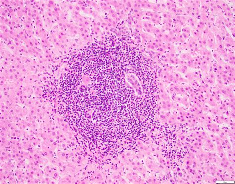 Hepatitis C Liver Histology