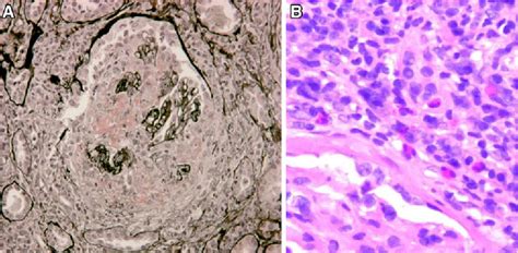 Pathology of ANCA-associated vasculitis | Semantic Scholar