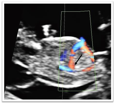 Cureus | The Incidence of the Agenesis of Fetal Ductus Venosus at the ...