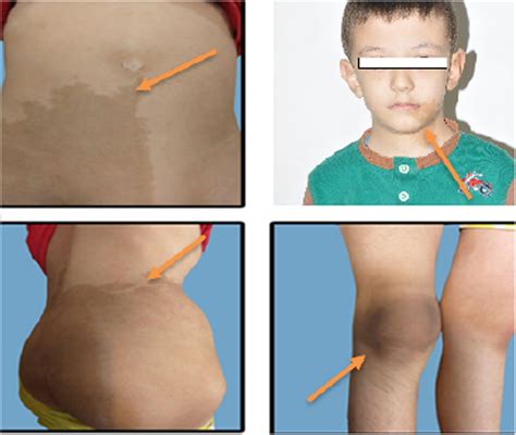 A case report of McCune–Albright syndrome with hepatic manifestations - Haddadi - 2022 ...