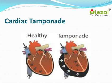 PPT - Cardiac Tamponade: Overview, Symptoms, Signs, Causes, Risk factor ...