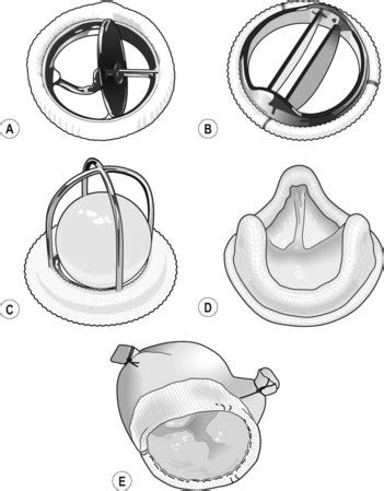 Prosthetic heart valves | Basicmedical Key