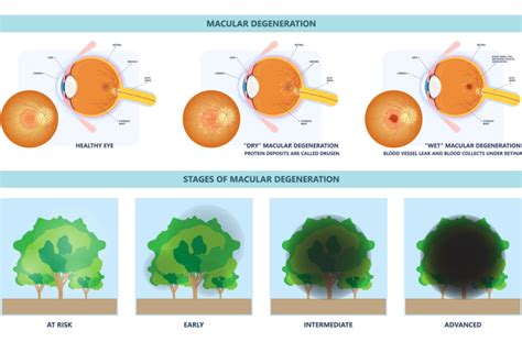 Is Macular Degeneration Hereditary? | Mississauga