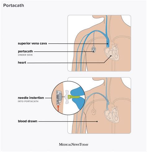 Portacath: What is it, why is it used, and more