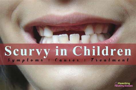 Scurvy in Children: Symptoms, Causes and Treatment