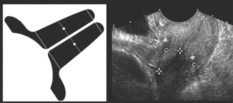 ULTRASOUND EVALUATION OF THE CERVIX | Radiology Key