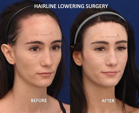 Forehead Reduction Surgery Hairline Lowering Surgery Before and After Photos | Forehead ...