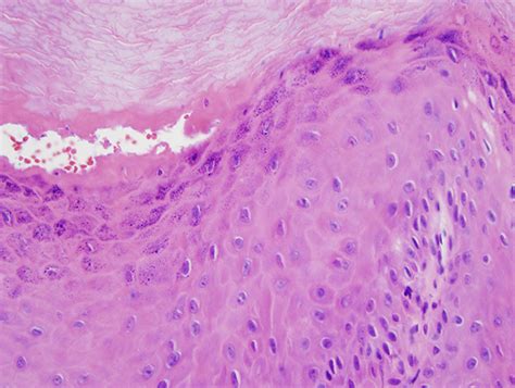 Onychopapilloma with Supervening Warty Changes | Dermatopathology