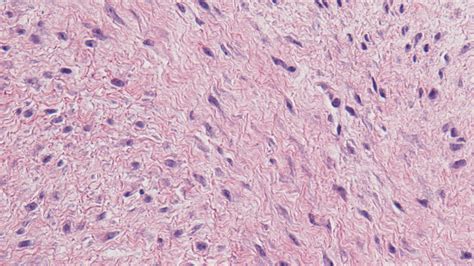 Superficial fibromatosis - MyPathologyReport.ca