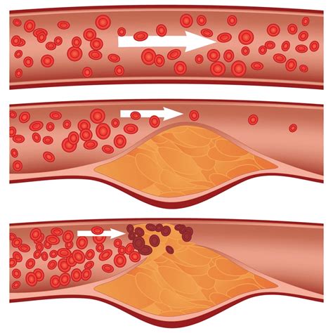 Warning Signs of Clogged Arteries: Commonwealth Vein Center: Vascular, Vein and Wound Specialists