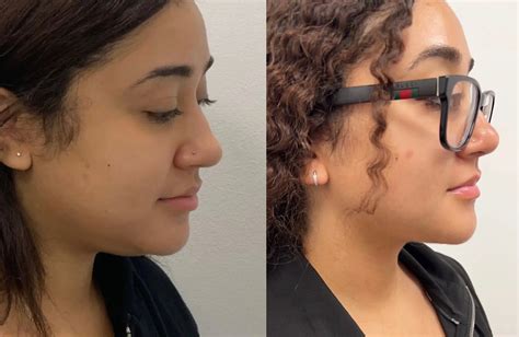 Double Chin Lipo - Adam J. Oppenheimer, MD