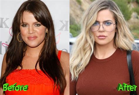 The History of Khloe Kardashian Plastic Surgery Procedures