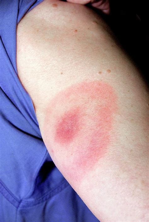 Lyme Disease Rash Photograph by James Gathany/cdc - Pixels